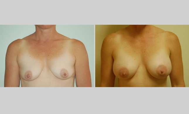 Breast Augmentation: Image #6