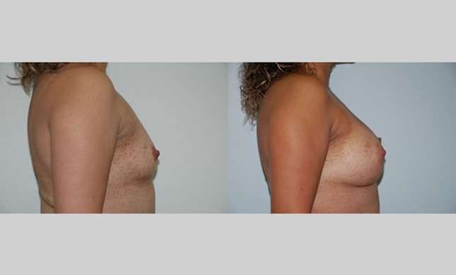 Breast Augmentation: Image #60