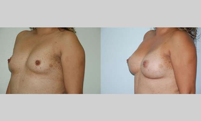 Breast Augmentation: Image #61