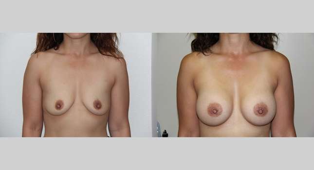 Breast Augmentation: Image #614