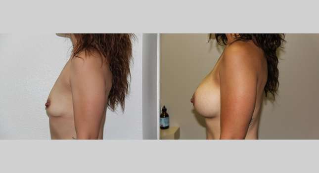 Breast Augmentation: Image #615
