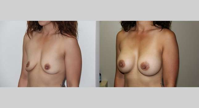 Breast Augmentation: Image #616