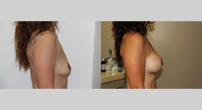 Breast Augmentation: Image #617