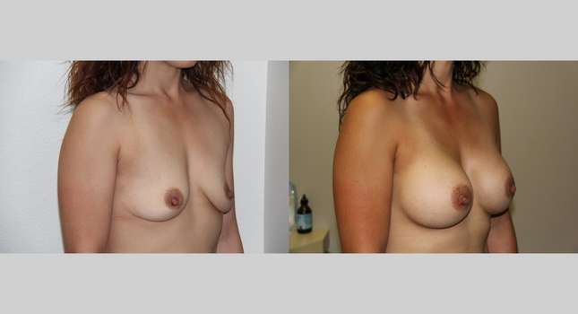 Breast Augmentation: Image #618