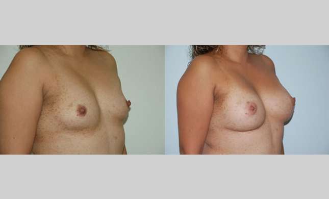 Breast Augmentation: Image #62