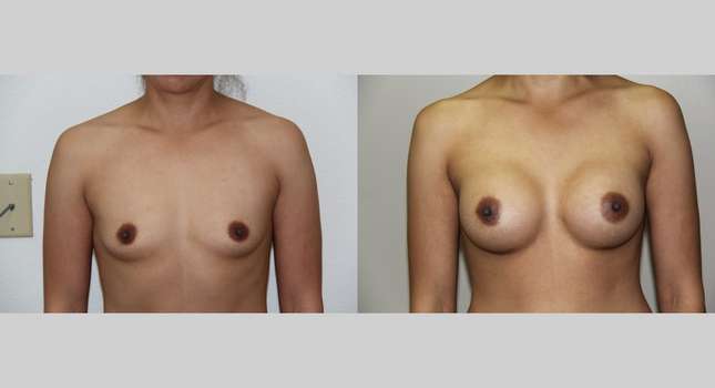 Breast Augmentation: Image #627