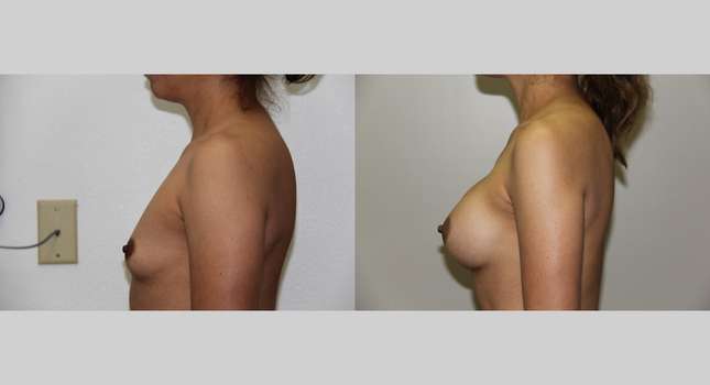 Breast Augmentation: Image #628