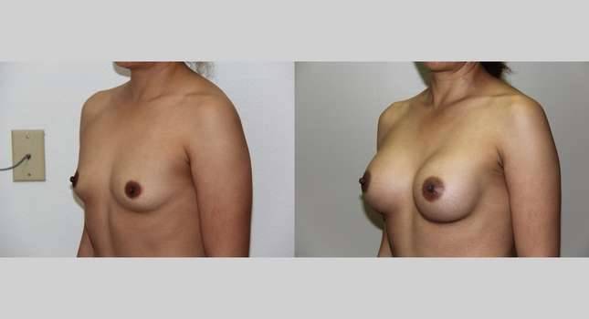 Breast Augmentation: Image #629