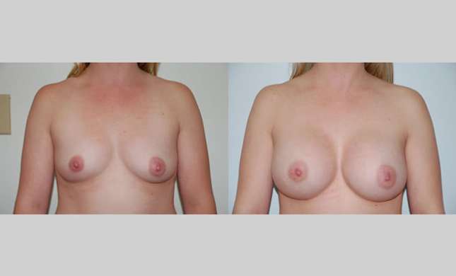Breast Augmentation: Image #63