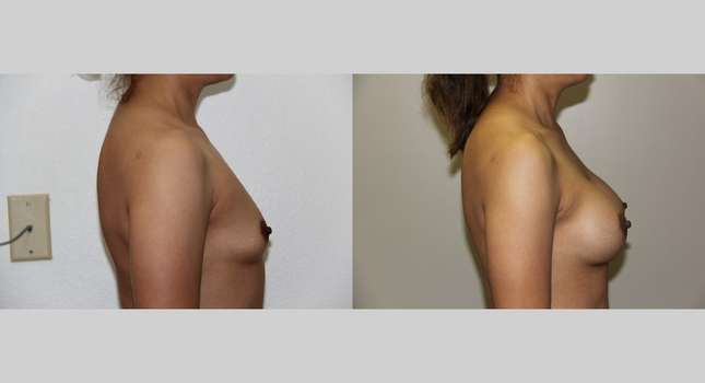 Breast Augmentation: Image #630
