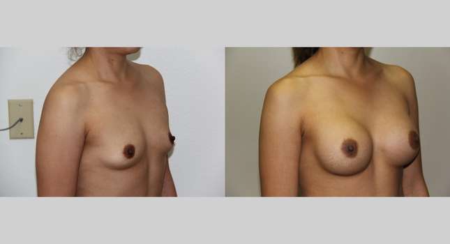 Breast Augmentation: Image #631