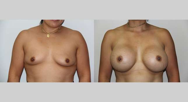 Breast Augmentation: Image #636