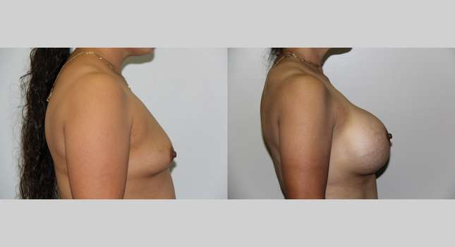 Breast Augmentation: Image #637