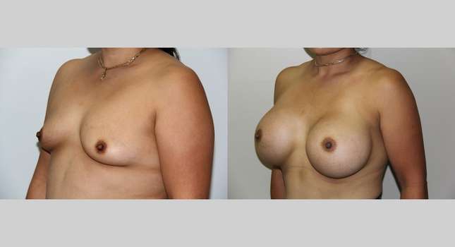 Breast Augmentation: Image #638