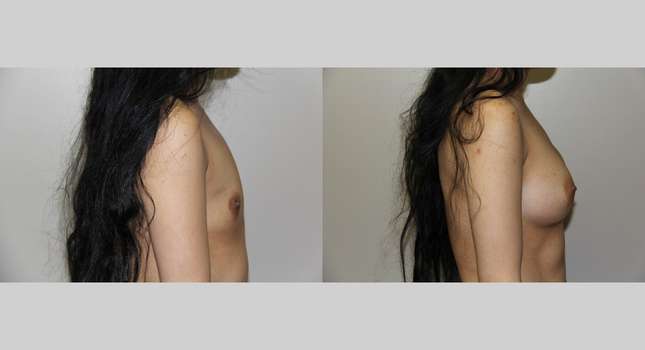 Breast Augmentation: Image #639