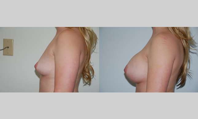 Breast Augmentation: Image #64