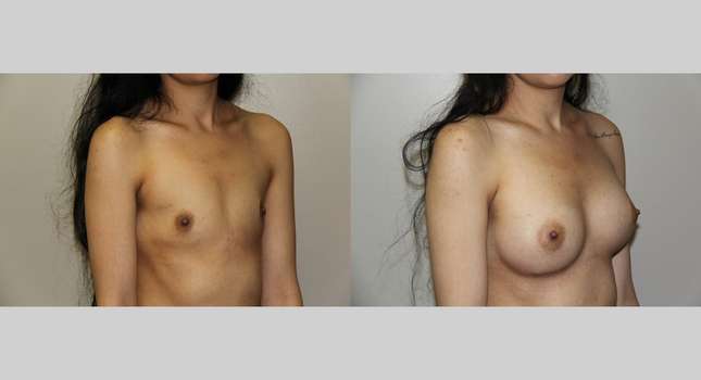 Breast Augmentation: Image #641