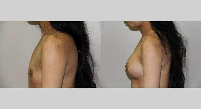 Breast Augmentation: Image #642