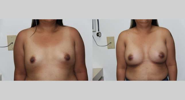 Breast Augmentation: Image #643