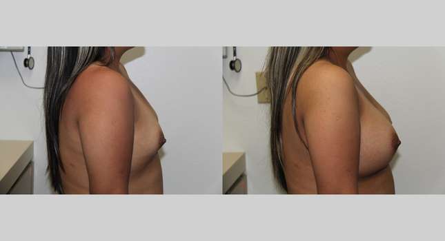 Breast Augmentation: Image #645