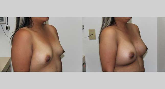 Breast Augmentation: Image #646