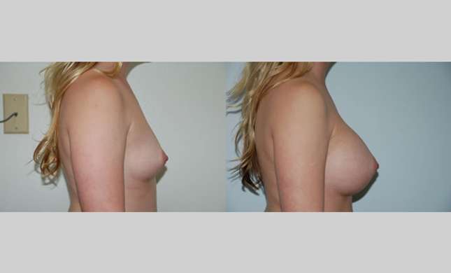 Breast Augmentation: Image #65