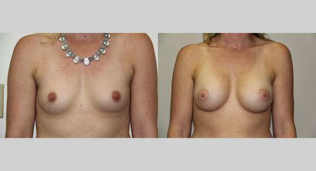 Breast Augmentation: Image #652
