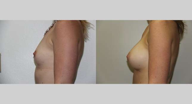Breast Augmentation: Image #653