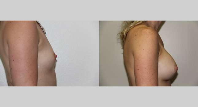 Breast Augmentation: Image #654