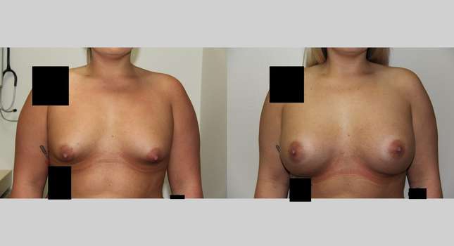 Breast Augmentation: Image #658