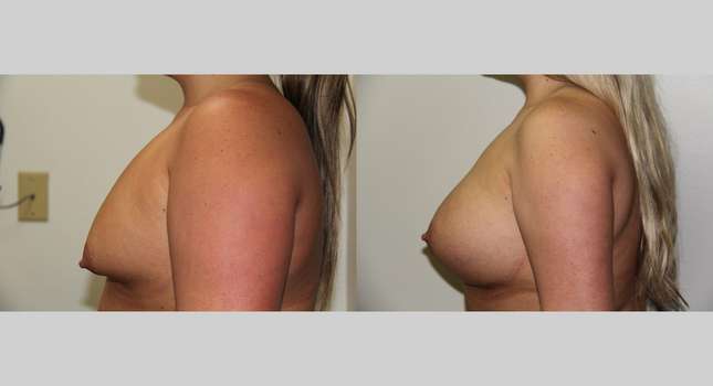 Breast Augmentation: Image #659