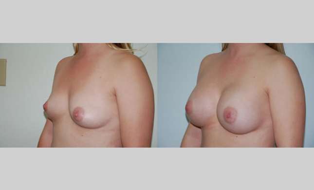 Breast Augmentation: Image #66