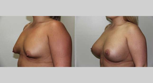 Breast Augmentation: Image #660
