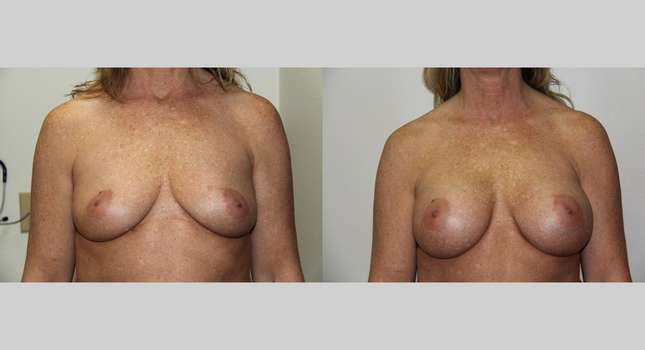 Breast Augmentation: Image #661
