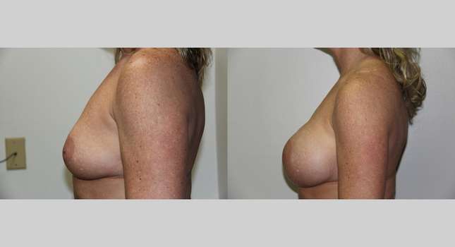 Breast Augmentation: Image #662