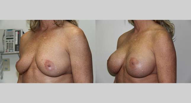 Breast Augmentation: Image #663