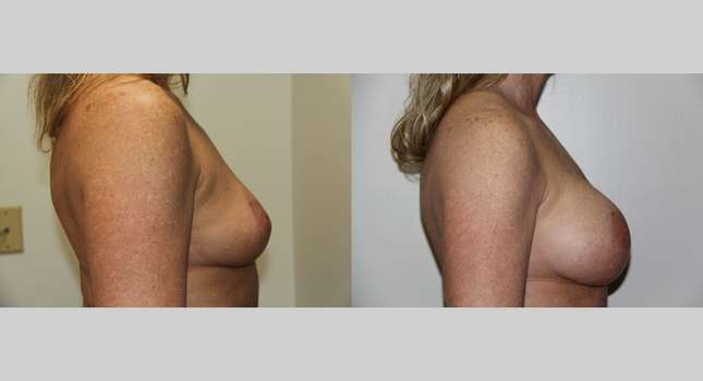 Breast Augmentation: Image #664
