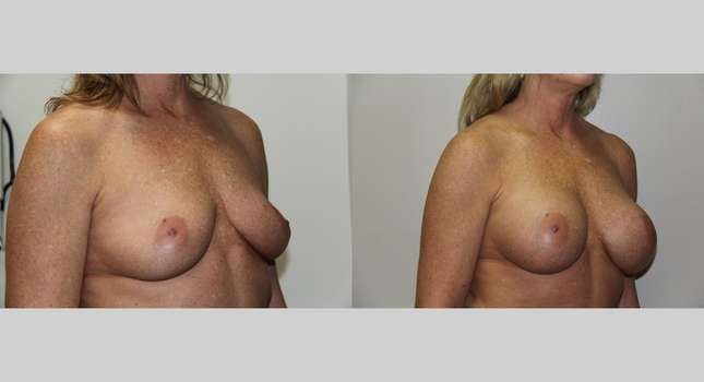 Breast Augmentation: Image #665