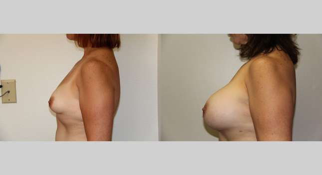 Breast Augmentation: Image #666