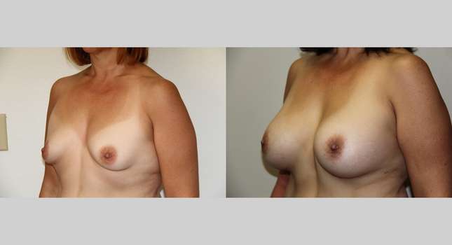 Breast Augmentation: Image #667