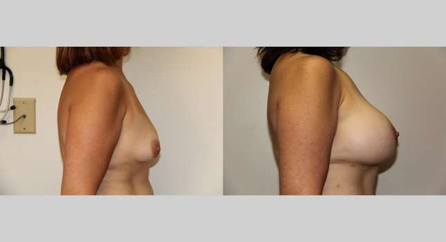 Breast Augmentation: Image #668