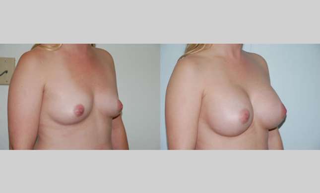 Breast Augmentation: Image #67