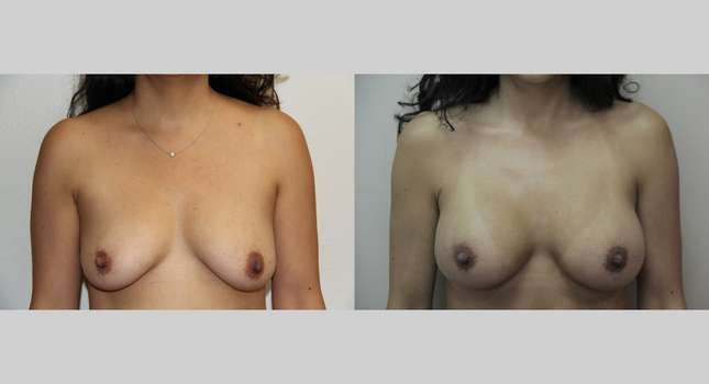 Breast Augmentation: Image #679