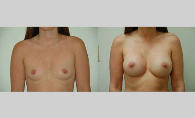 Breast Augmentation: Image #68