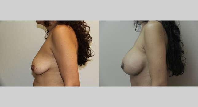 Breast Augmentation: Image #680