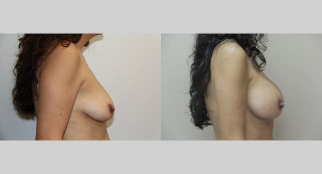 Breast Augmentation: Image #681