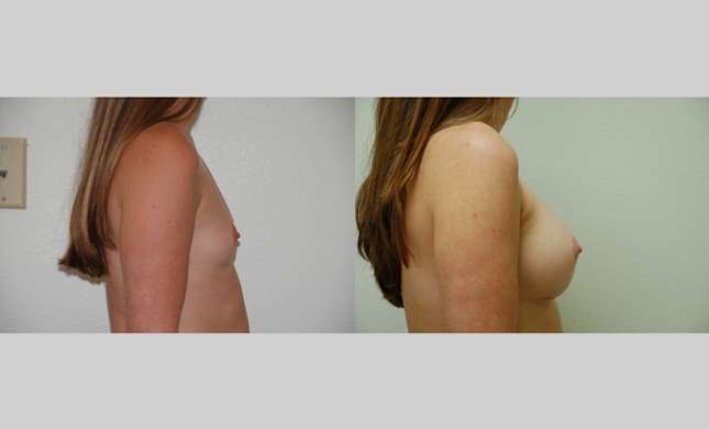 Breast Augmentation: Image #69