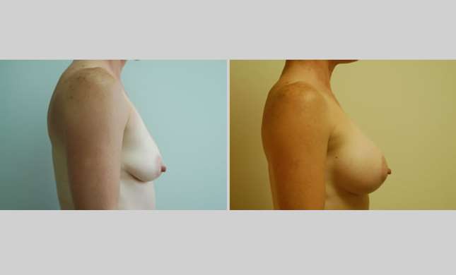 Breast Augmentation: Image #7