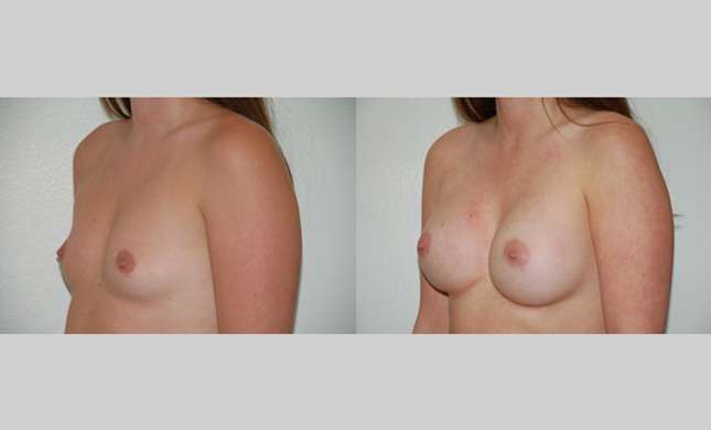 Breast Augmentation: Image #70