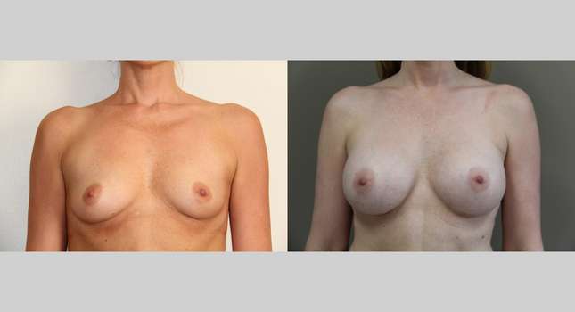 Breast Augmentation: Image #704